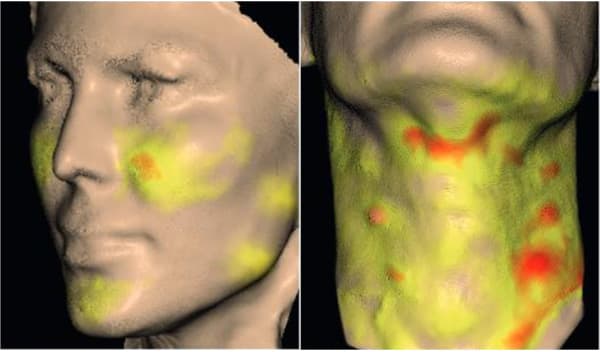 PROFHILO逆時針臉部分布圖