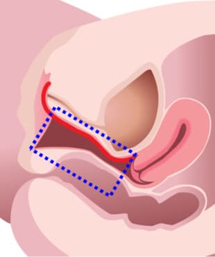 Step1.全陰道壁的支撐力加強
