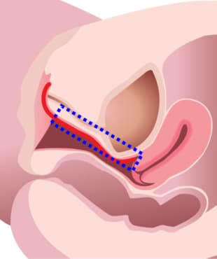 Step2.陰道前壁重點治療