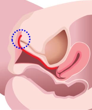 Step3.陰道前壁入口處:外陰前庭及尿道括約肌區域