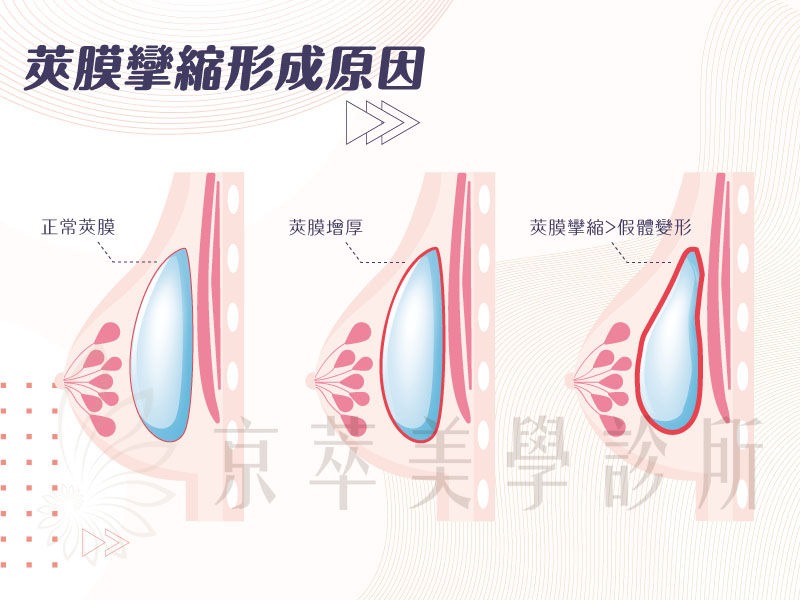 莢膜孿縮的形成原因