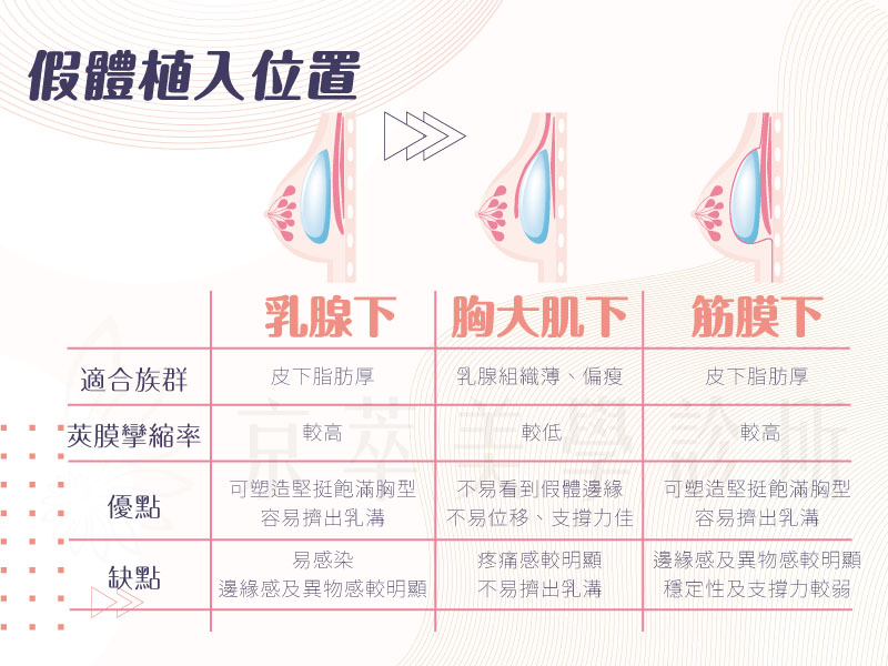 隆乳手術假體植入位置