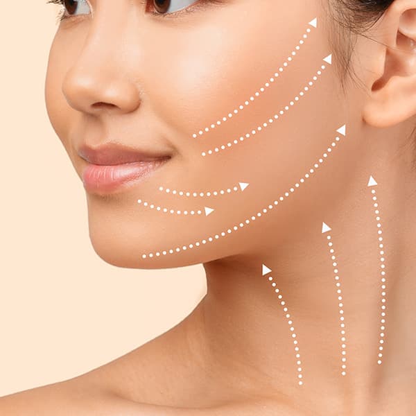 中下臉拉皮示意圖