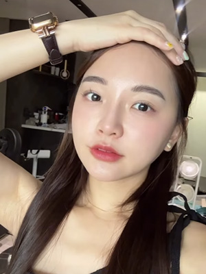 眼袋消失、遮瑕膏進冷宮！我的眼袋手術真實分享